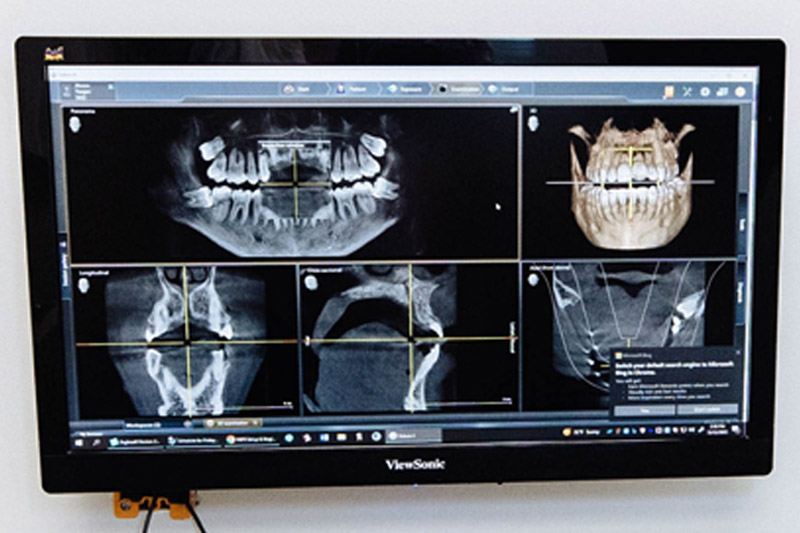 Digital X-Rays in 